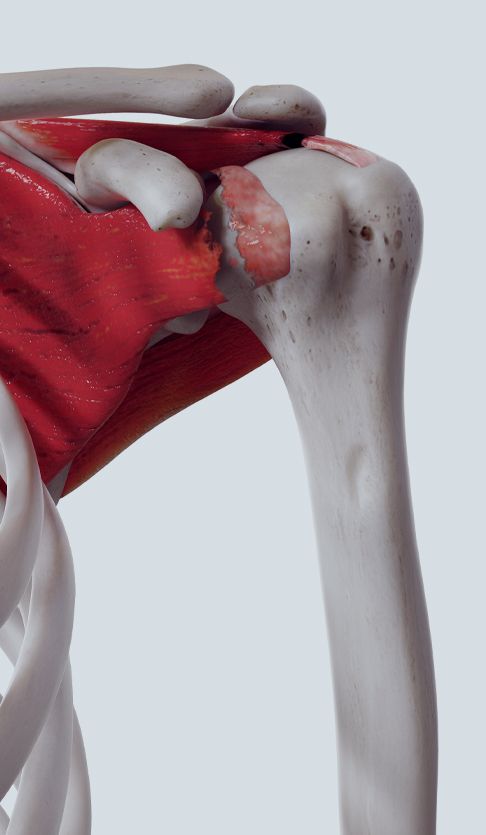 Rotator Cuff Tear