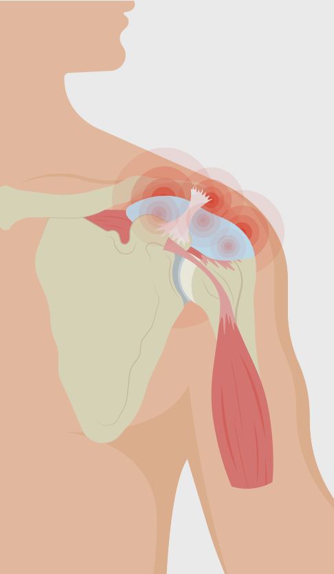 Bursitis