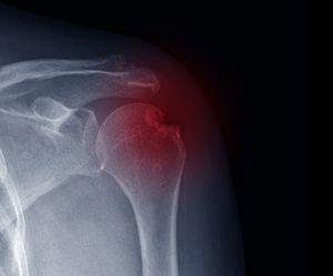 Shoulder Fracture
