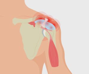 Bursitis