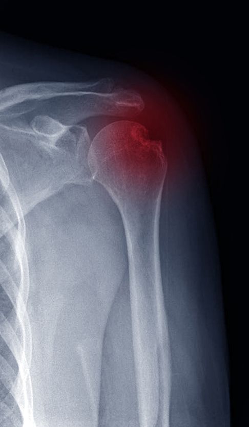 Shoulder Fracture