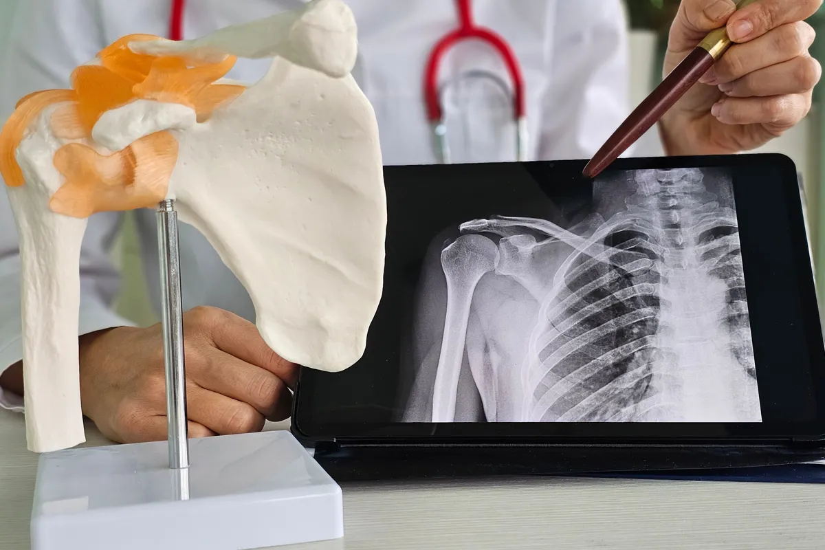 Orthopaedic surgeon explaining shoulder injury with a shoulder model and x-ray.